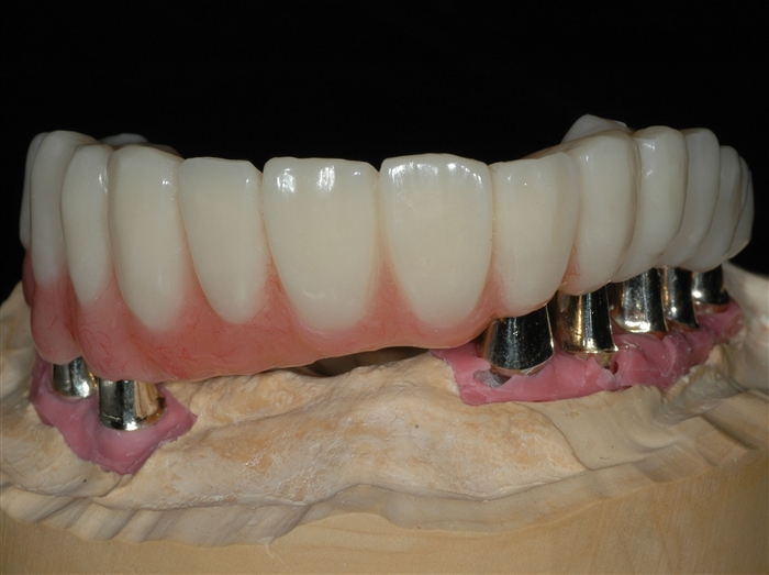 abutment required for implant treatment