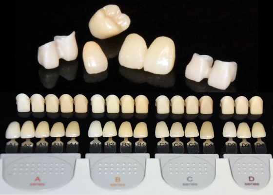 compare zirconia emax metal bond