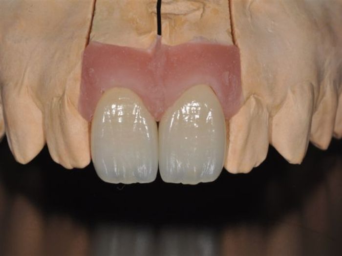 zirconia compatibility